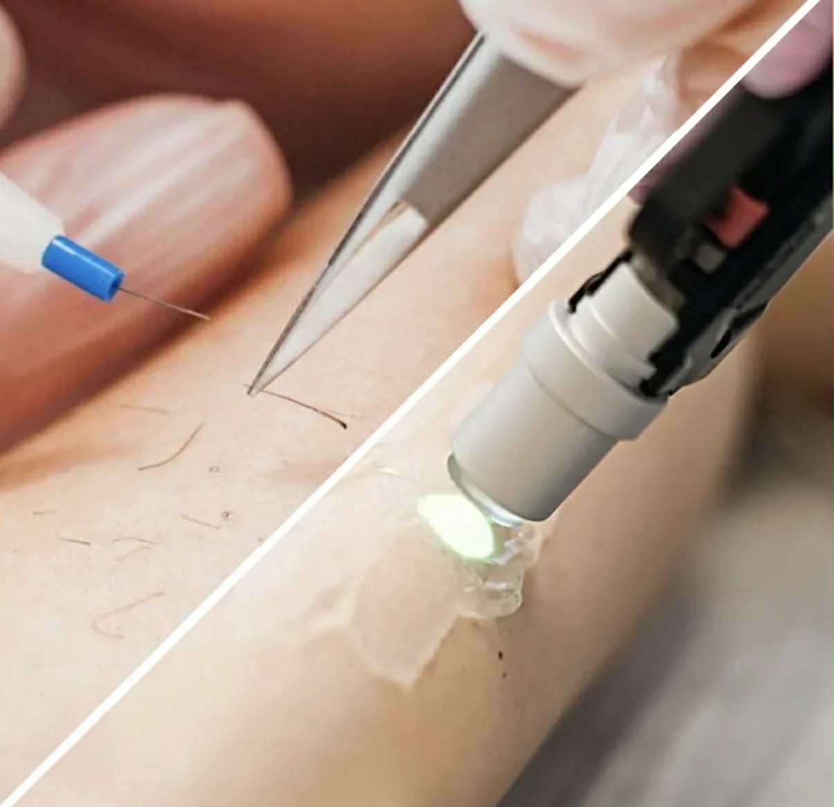 Porównanie elektroepilacji i depilacji laserowej